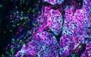 Evident Multiplexed Fluorescent Lung Tissue sample stained with Ultivue PD-L1 kit imaged